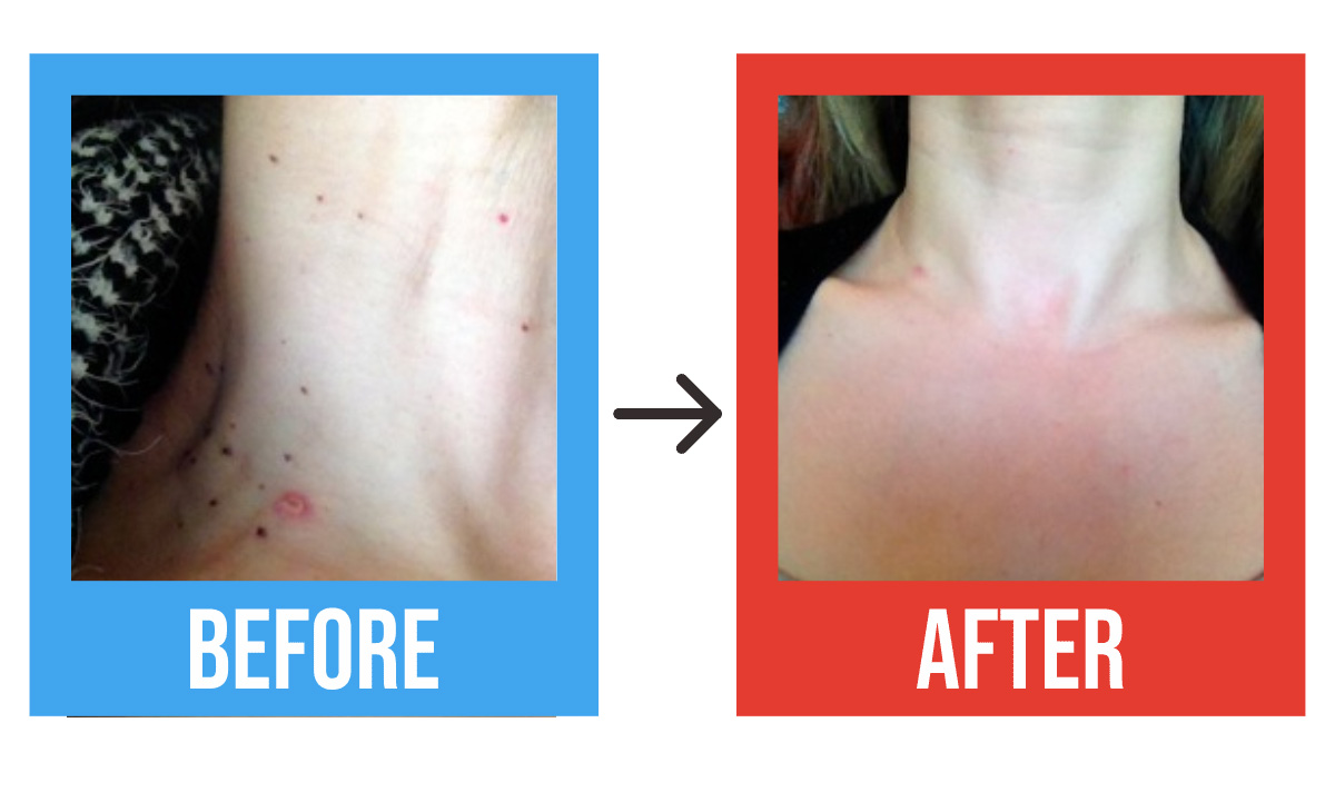 Skin tags and spots removal